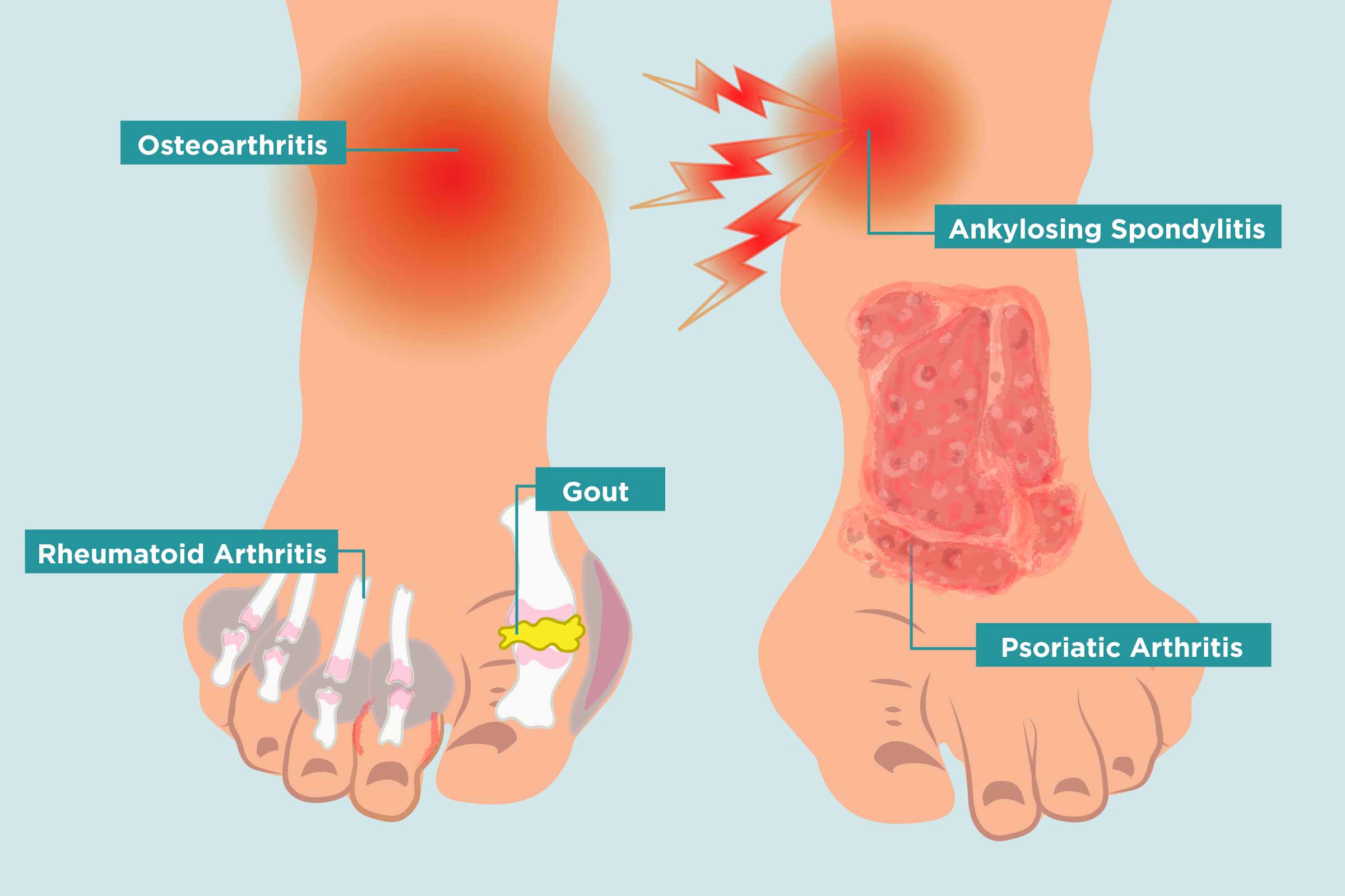 Arthritis in Your Feet: Causes, Symptoms, and Treatment