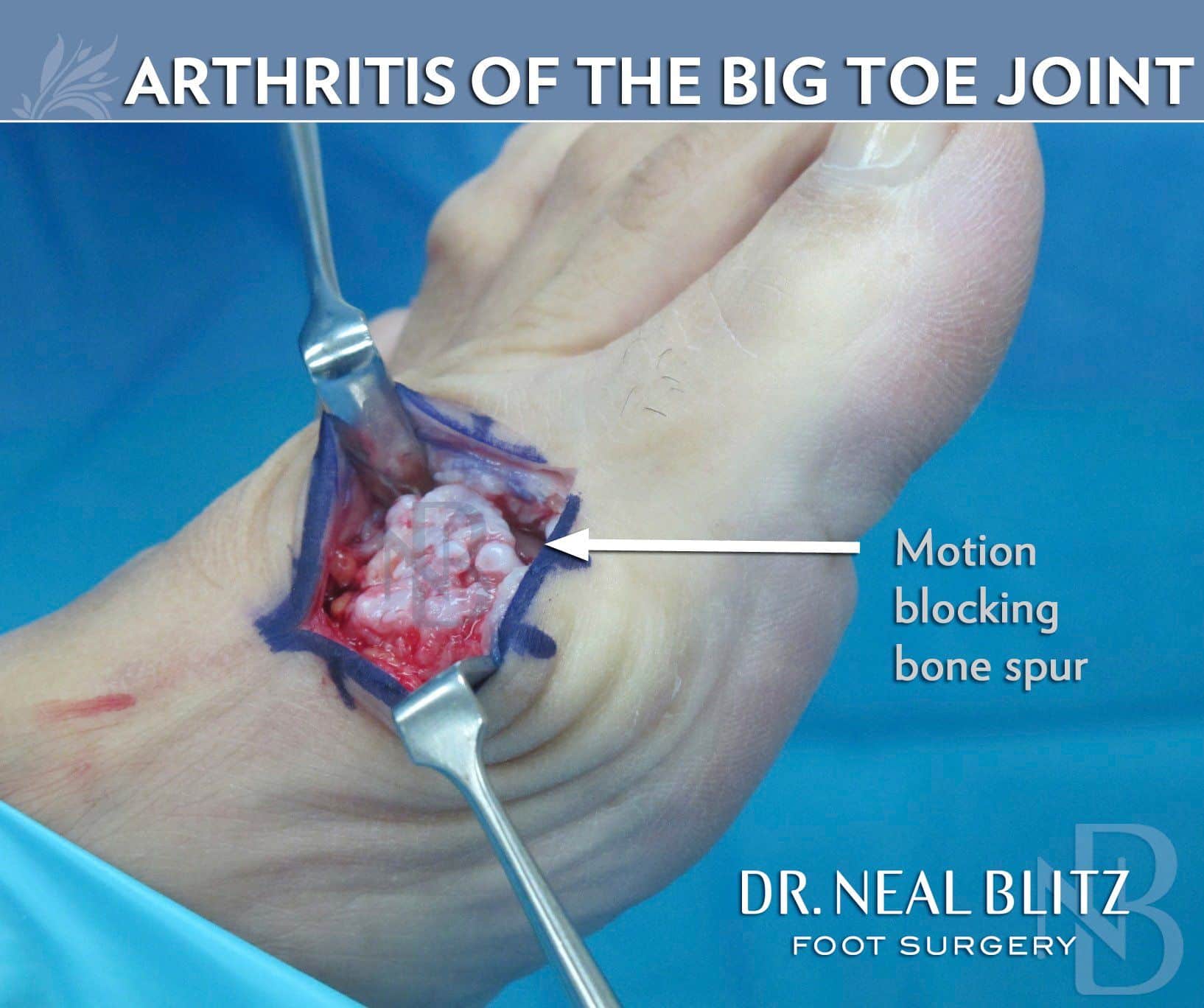 Big Toe Arthritis Surgery â Learn about Symptoms &  Treatment