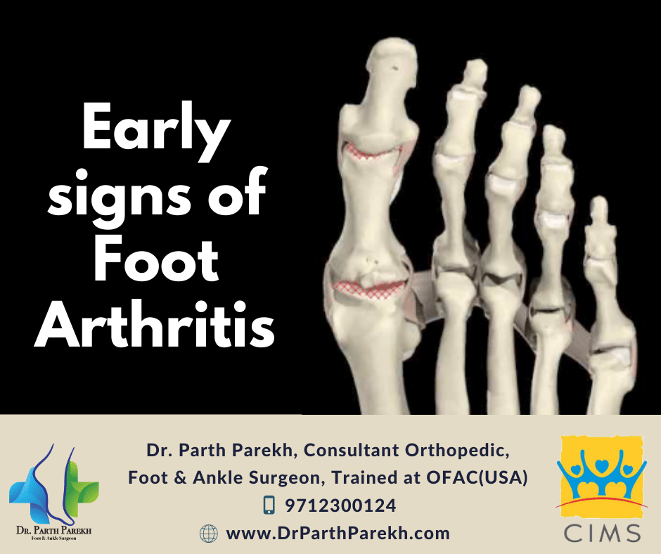 Early signs of Foot Arthritis