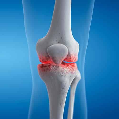 Knee Arthritis