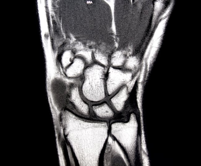 Rheumatoid Arthritis Disease Progression on MRI Despite ...